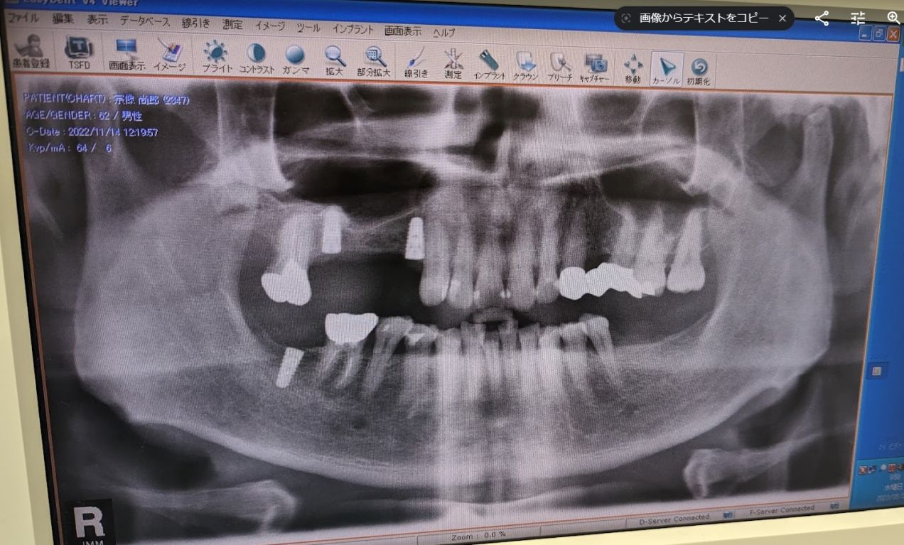 tooth_state_20221114.jpg
