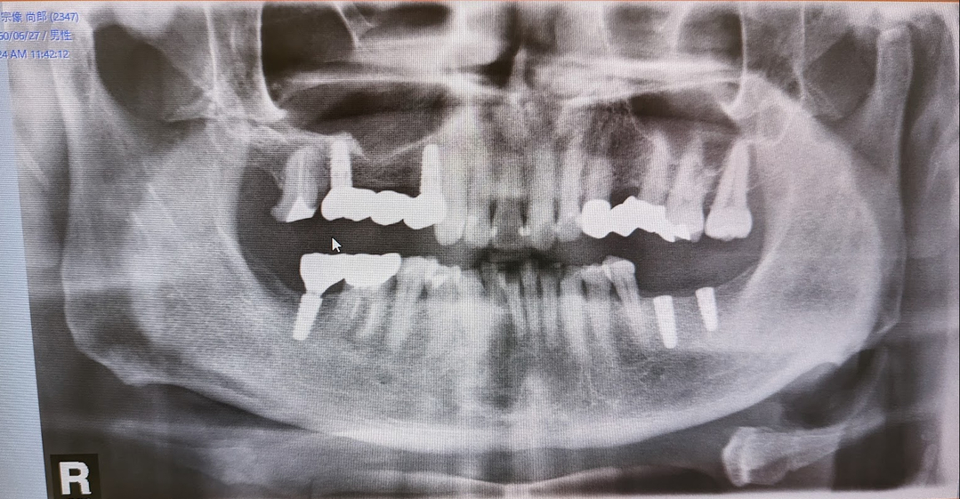 tooth_state_20230524.jpg